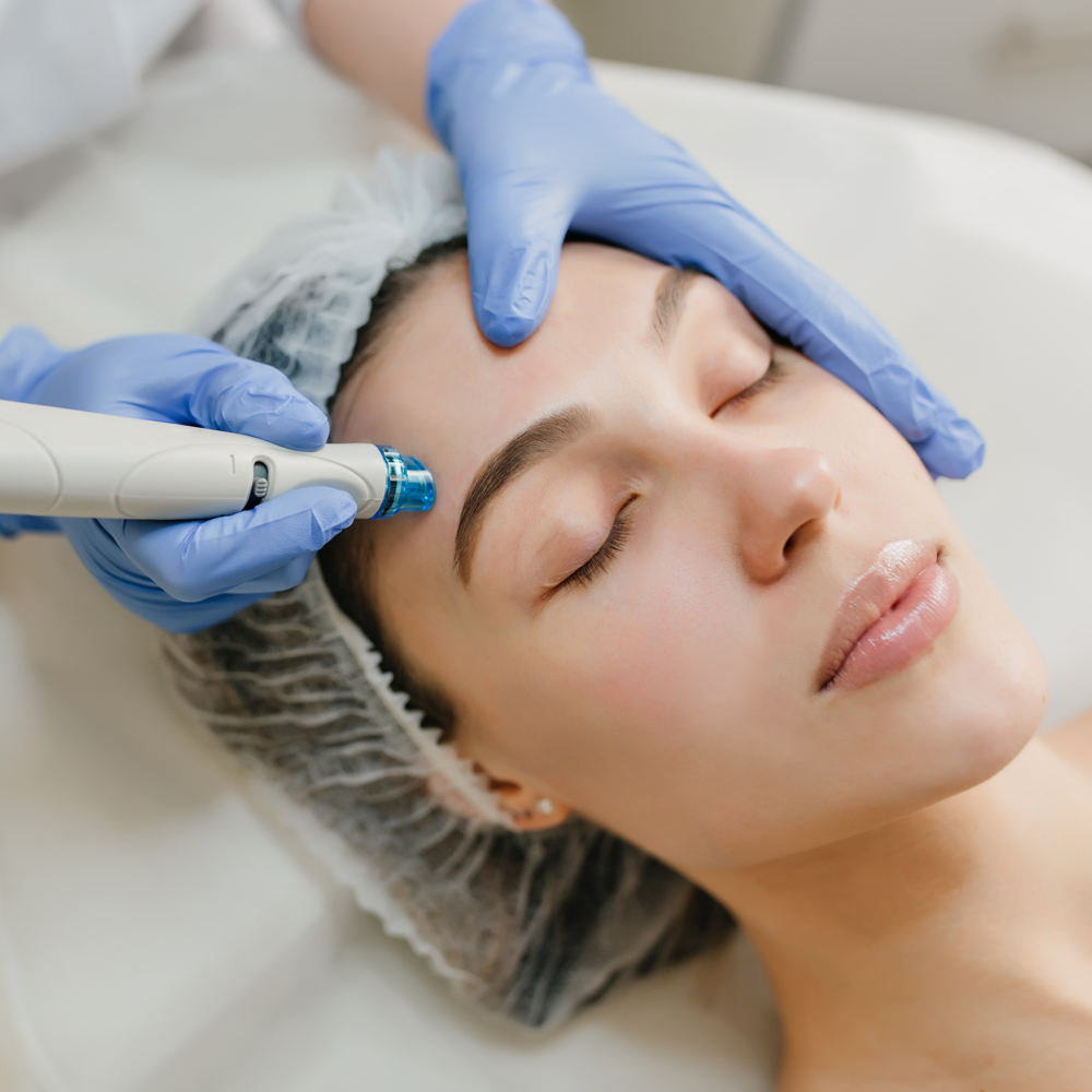 Tratamiento facial con microneedling